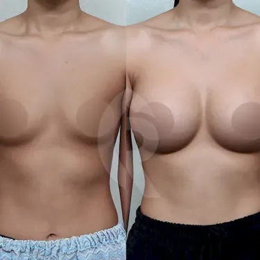 Breast augmentation