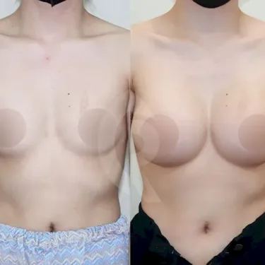 Breast augmentation
