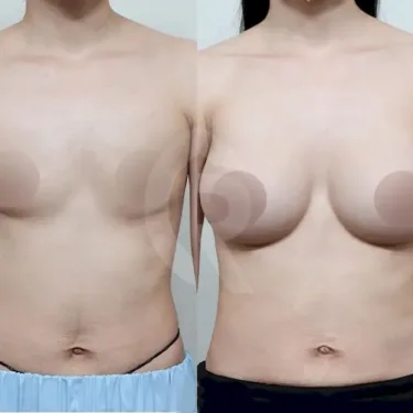 Breast augmentation
