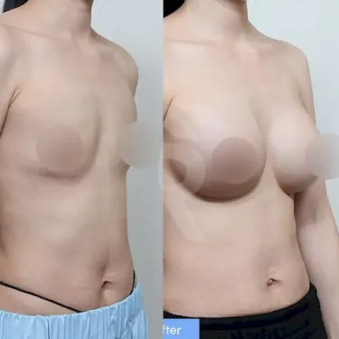 Breast augmentation