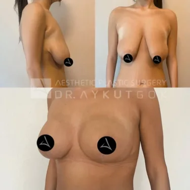 Breast Lift