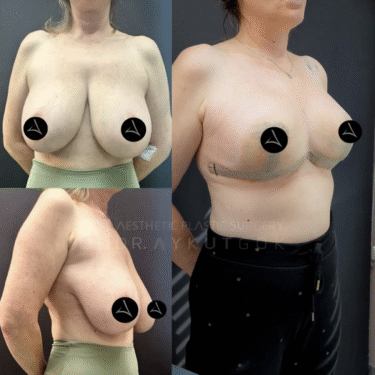 Breast Reduction