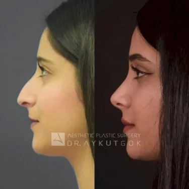 Rhinoplasty