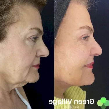 Подтяжка лица и шеи