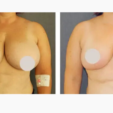 Breast Reduction
