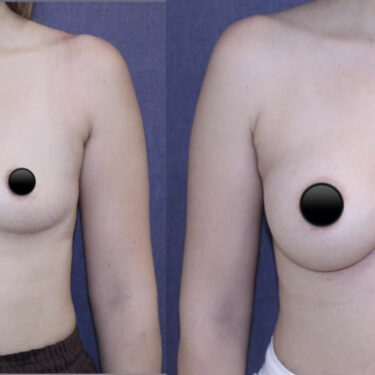 Breast Augmentation
