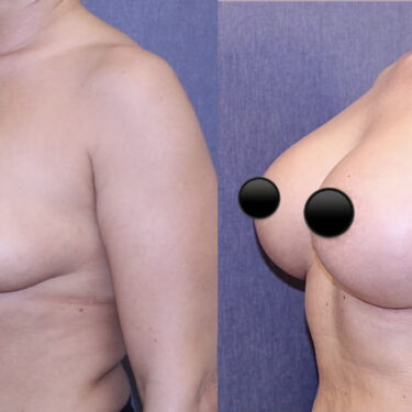 Breast Augmentation