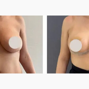 Breast Reduction