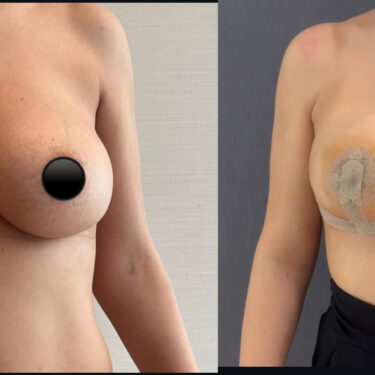 Breast Reduction