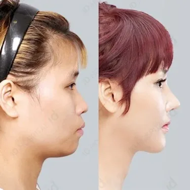 Ринопластика