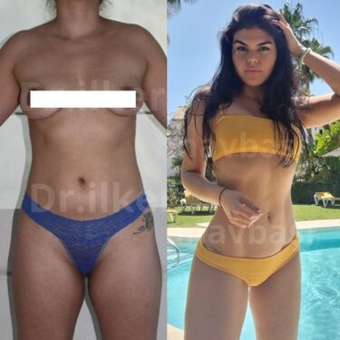 Липосакция