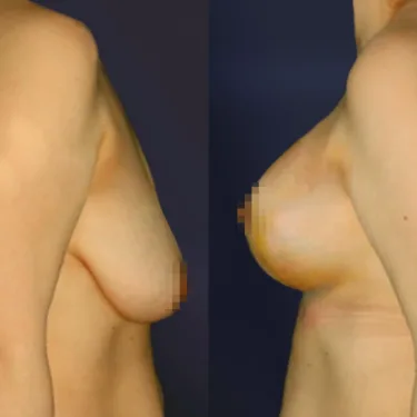 Подтяжка груди