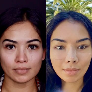 Подтяжка лица и шеи