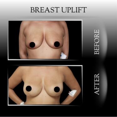 Breast Lift