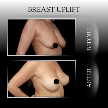 Подтяжка груди