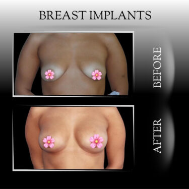 Увеличение груди с помощью имплантатов