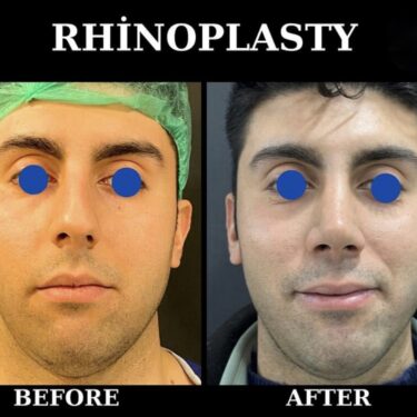 Септопластика