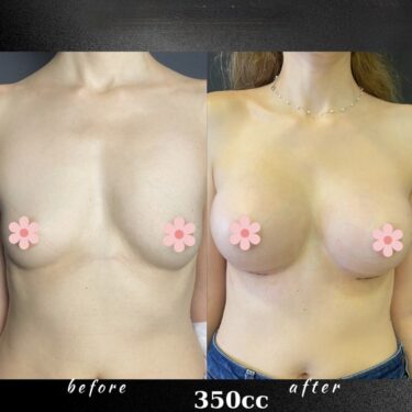 Увеличение груди