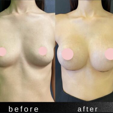 Увеличение груди