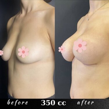 Увеличение груди