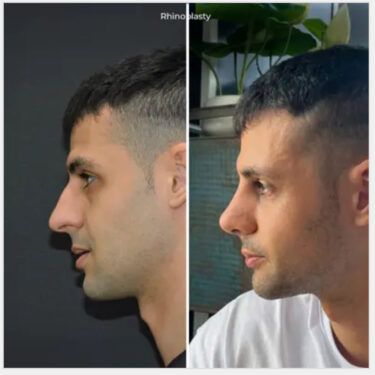 Ринопластика