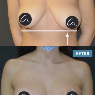Breast Lift