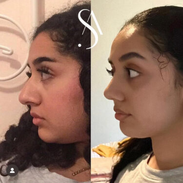 Ринопластика