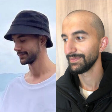 Ринопластика