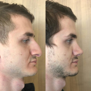 Ринопластика