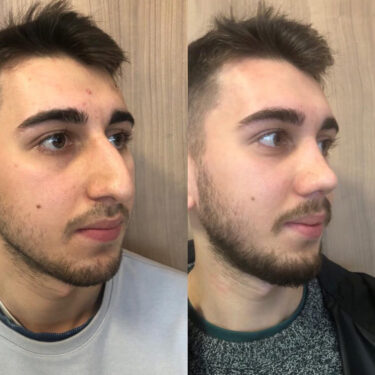 Ринопластика