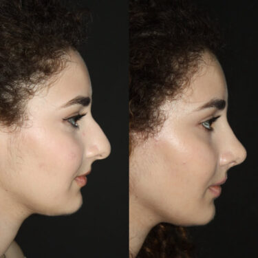 Ринопластика