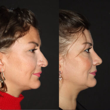 Ринопластика