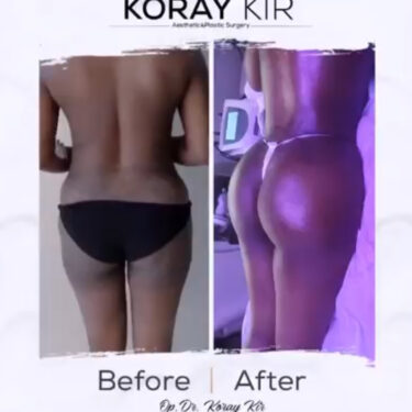  Brazilian Butt Lift (BBL)