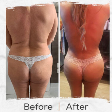  Brazilian Butt Lift (BBL)