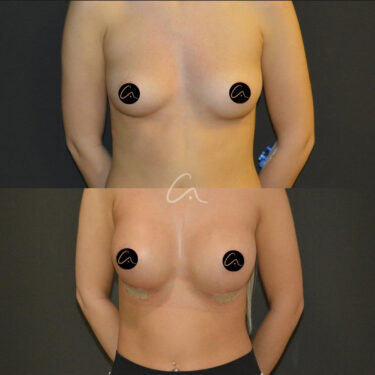 Увеличение груди