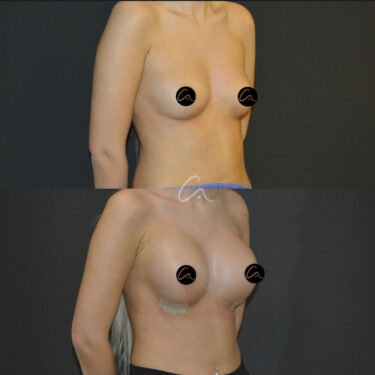 Увеличение груди