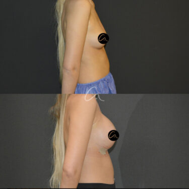 Увеличение груди