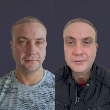 Блефаропластика
