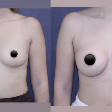 Увеличение груди
