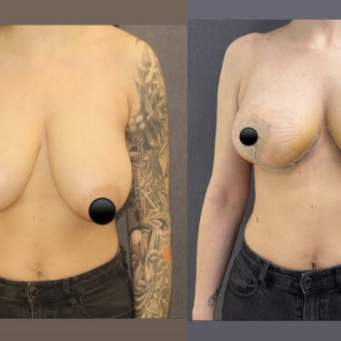 Breast Lift