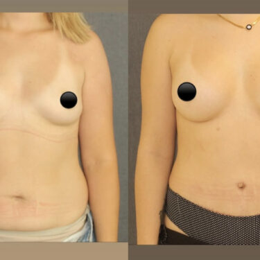 Увеличение груди