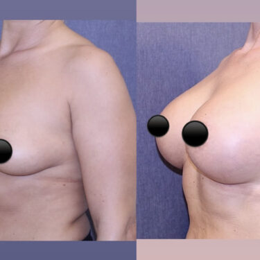 Увеличение груди