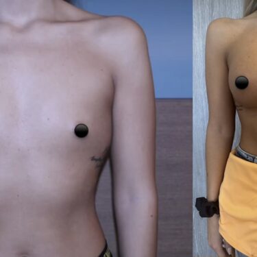 Увеличение груди