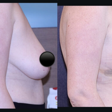 Breast Lift