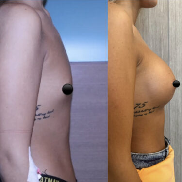 Увеличение груди