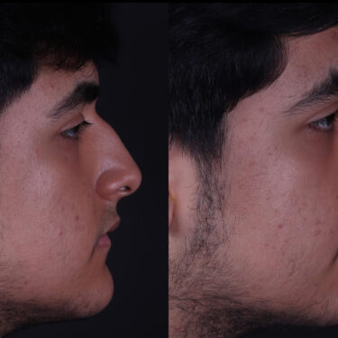 Ринопластика