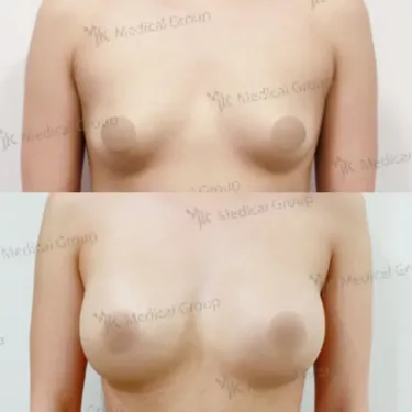 Mammoplasty - Breast Augmentation