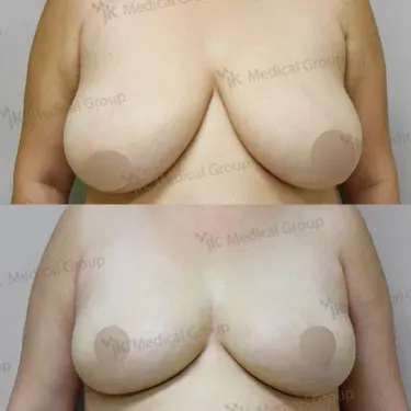 Mammoplasty - Breast reduction