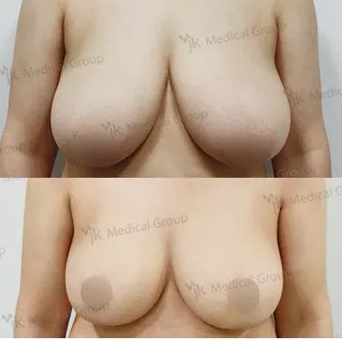 Mammoplasty - Breast reduction