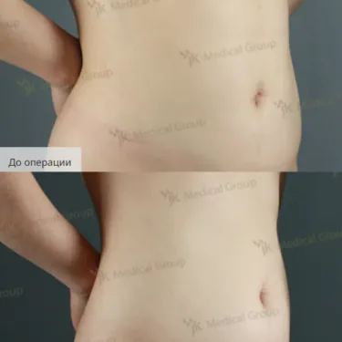 Liposuction 